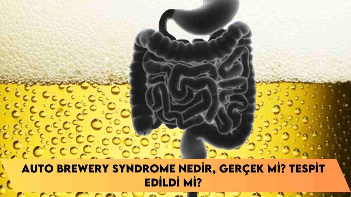 Auto Brewery Syndrome nedir, gerçek mi? tespit edildi mi?