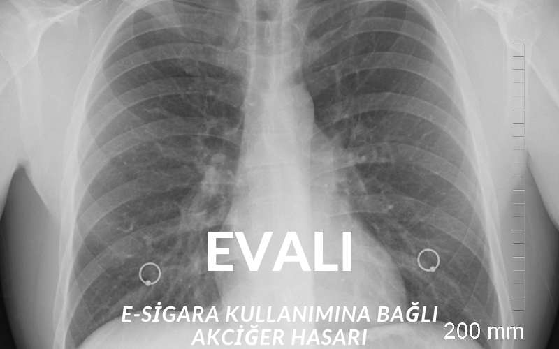 Evali ne demek? Evali açılımı nedir? EVALI nedir?