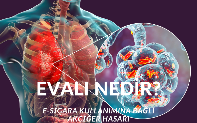 Evali Hastalığı Nedir? Evali Belirtileri Nelerdir? Elektronik Sigaraya Bağlı Akciğer Hasarı EVALI Kimlerde Görülür?