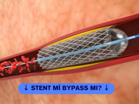 stent mi bypass mı?